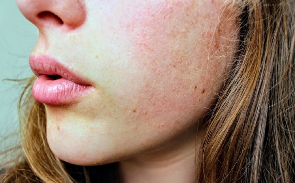 6 Skin Problems Youll Face This Winter and How to Fix Them
